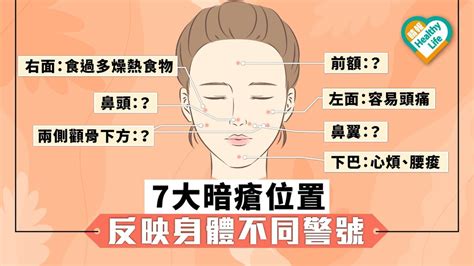 額角 暗瘡|12個暗瘡位置揭示身體狀況｜中醫拆解人中、下巴、額 